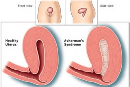 چسبندگی رحم، علل و راهکارهای درمان
