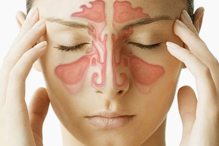 درمان سینوزیت بدون دارو