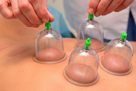 حجامت چیست؟ کاربرد‌ها و مزایای آن را بخوانید