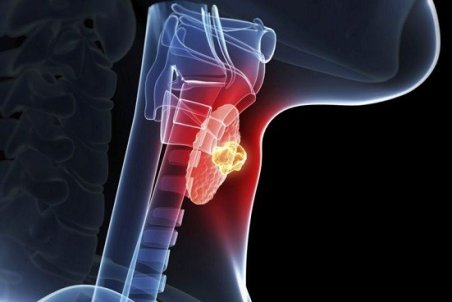 روش درمان کم کاری تیروئید