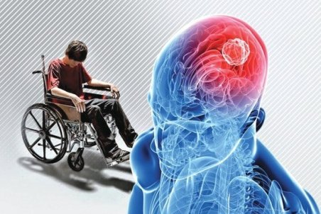 آنچه باید در مورد ام اس بدانیم