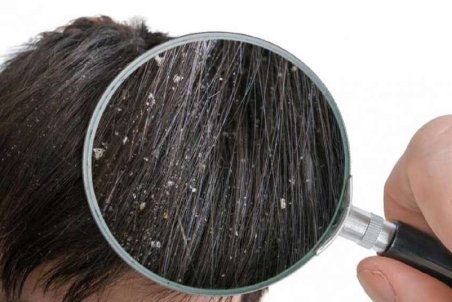 بهترین روش برای جلوگیری از شوره سر