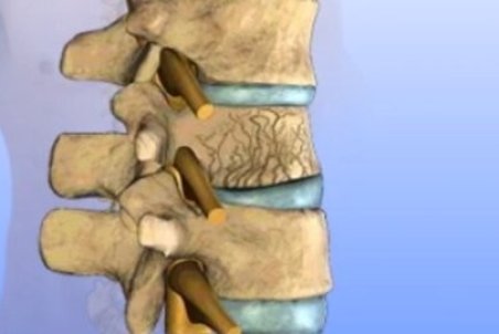 جراحی شکستگی ستون فقرات چیست؟