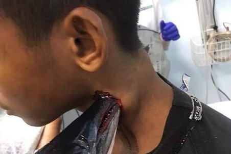 (تصاویر +16) ماهی سر سوزنی گردن یک نوجوان را سوراخ کرد!