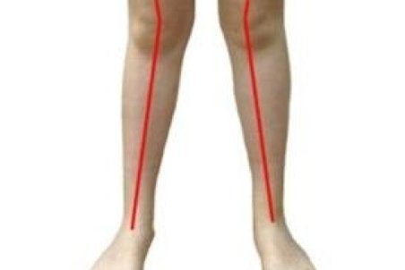 ۴ حرکت اصلاحی برای ناهنجاری "زانوی خم"