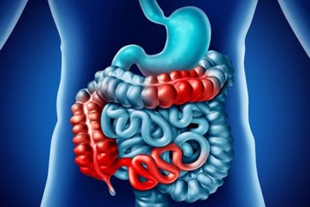 بیماری کرون و کولیت زخمی چه تفاوت‌هایی دارند؟