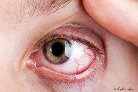 علت و درمان سوزش چشم