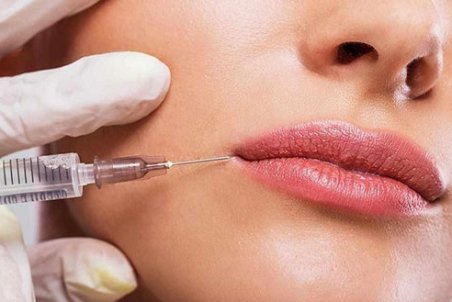 تزریق ژل به لب چگونه است و چقدر ماندگاری دارد؟