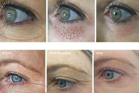 پلاسماجت چیست و چه کاربردی دارد؟