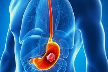 میکروب معده علائم بالینی ندارد