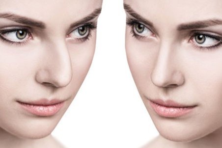 رینو‌پلاستی چیست و چگونه انجام می‌شود؟