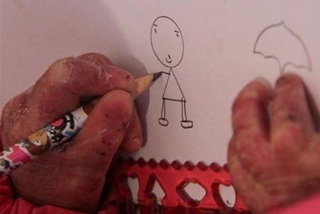 بیماری پروانه‌ای را بهتر بشناسید