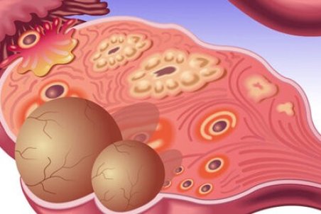 کیست تخمدان سراغ کدام زنان می‌آید؟