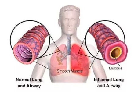 تفاوت "کرونا" با "برونشیت حاد"