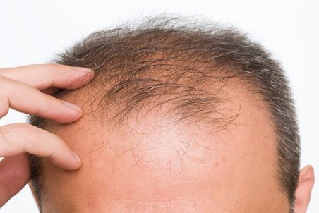 علت ریزش موی شدید چیست؟
