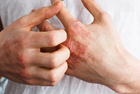 ویروس کرونا؛ برای رفع خارش پوست دست از چه کرمی استفاده کنیم؟