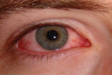 عارضه چشم صورتی می‌تواند از نشانه‌های ابتلا به کرونا باشد؟