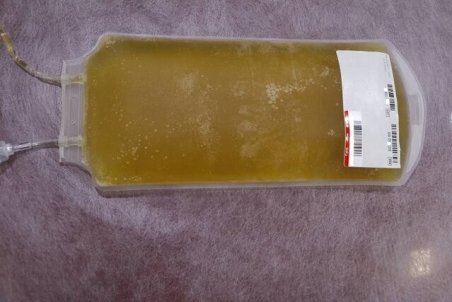 تاثیر مثبت پلاسمای خون بر درمان بیماران مبتلا به کرونا