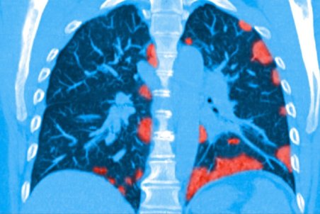 احتمال ماندگاری مشکلات ریوی در بیماران کرونایی