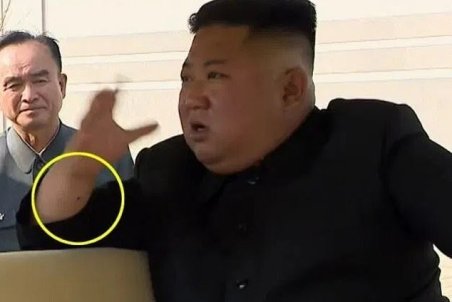 جای سوزن بر مچ کیم جونگ اون؛ رهبر کره شمالی عمل جراحی انجام داده است