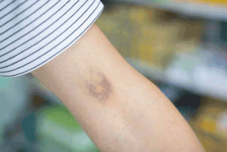 چرا بدن خودبخود کبود می‌شود؟