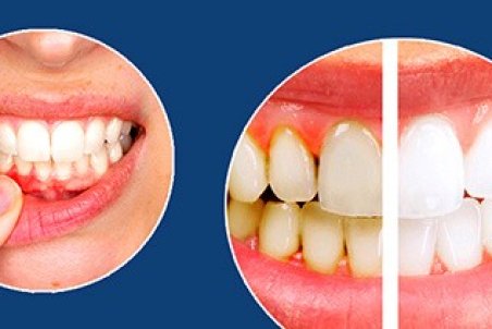 علل، علایم و درمان پیوره لثه