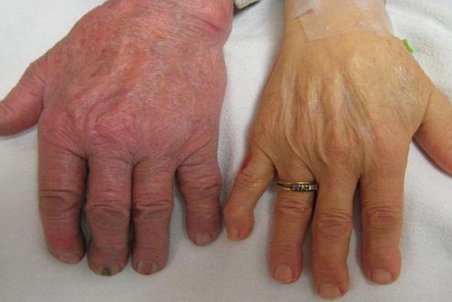 بیماری آدیسون را بیشتر بشناسید