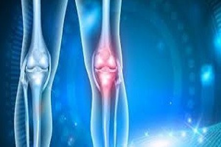 راه های جلوگیری از آرتروز زانو/آرتروز بیماری تخریب تدریجی غضروفِ مفصل