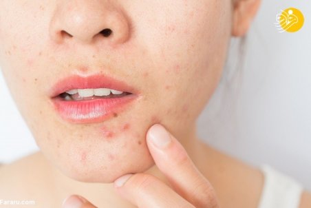 هر آنچه باید درباره درمان جوش صورت و آکنه بدانید