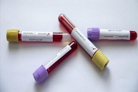 ماجرای گم شدن تست‌های کرونا در خوزستان چه بود؟