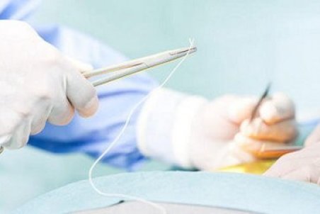 علت شیوع کیست در زنان و دختران چیست؟