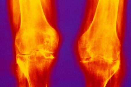 مهمترین علل زانوی پرانتزی چیست؟