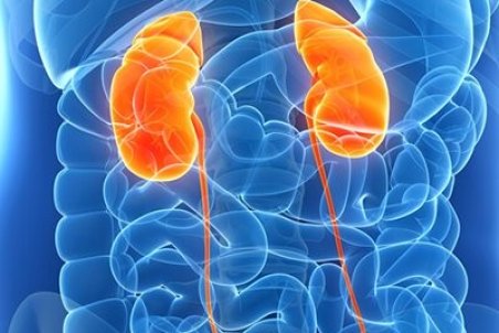 راه‌های درمان سنگ کلیه و پیشگیری از عود مجدد