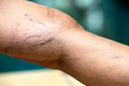 سیاهرگ‌های واریسی و عاداتی برای تسکین آنها