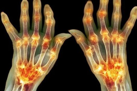 میوه‌هایی برای تسکین علائم التهاب مفصل