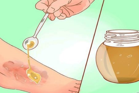 بهبود زخم‌ها با مواد طبیعی