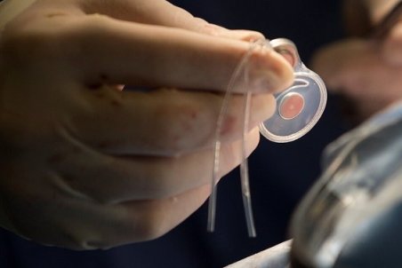 افزایش صف های کاشت حلزون شنوایی / لزوم مداخله زودهنگام در درمان ناشنوایان