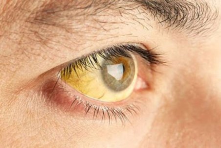 هشدار! هیپاتیت در کمین شماست، کبد را دریابید