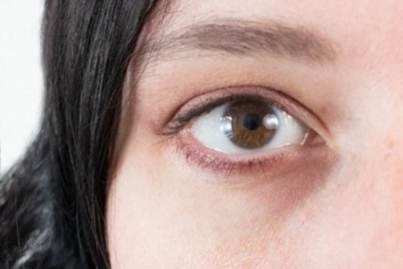 ﻿ طبیعی‌ترین درمان برای سیاهی دور چشم