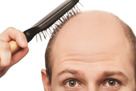 روش ساخت یک ترکیب گیاهی ساده برای جلوگیری از "ریزش مو"