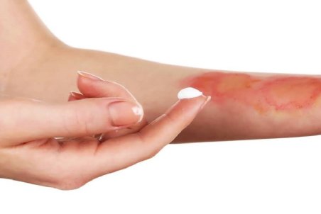 ۶ نسخه خانگی فوق العاده برای درمان آفتاب سوختگی