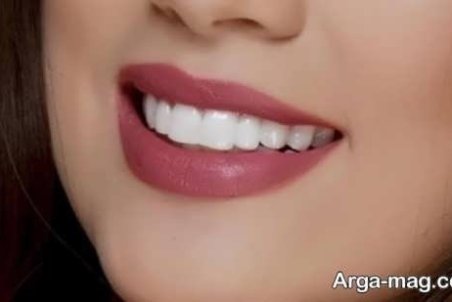 معایب اصلی کامپوزیت دندان ها