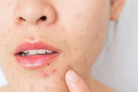 آیا مصرف ویتامین B۱۲ باعث جوش میشود؟