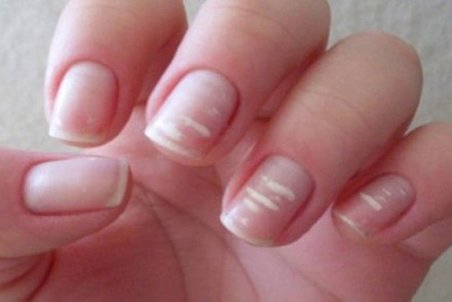 چرا روی ناخنم لكه‌های سفید ظاهر شده است؟
