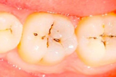 پوسیدگی و خرابی دندان درمان خانگی دارد؟