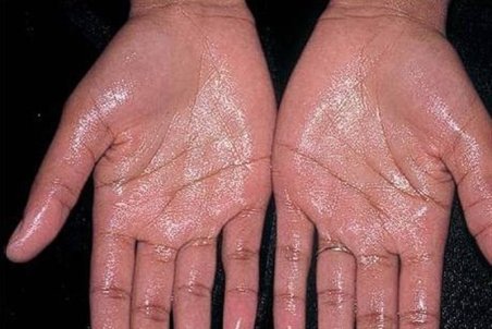 علت "تعریق زیاد کف دست" از منظر طب سنتی چیست + راهکار ساده درمانی