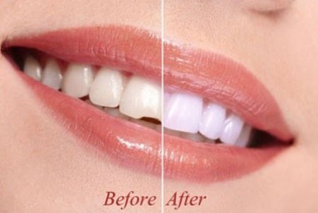 ﻿ باندینگ (پیوند) دندان چیست؟