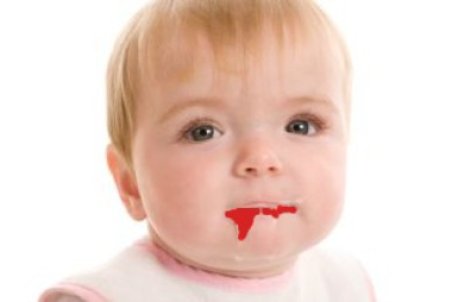 دلایل استفراغ خونی در نوزادان و کودکان