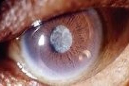 بیماری آب مروارید از دلایل و علائم تا درمان آن