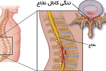با تنگی کانال نخاعی چه باید کرد؟ / چه ورزش‌هایی مناسب این عارضه هستند؟